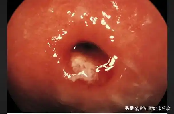 淋病的前世今生