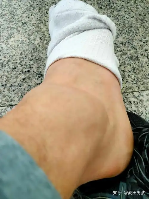 右踝关节扭伤崴脚恢复记录