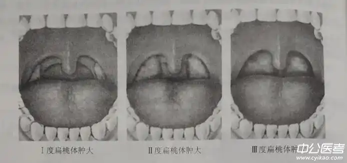 乡村助理医师实践技能考试第二站【体格检查】扁桃体检查