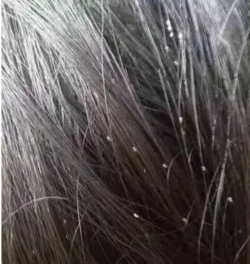 医生说,确实头发不清洁只是引起虱子寄生的原因之一,头虱的传染途径