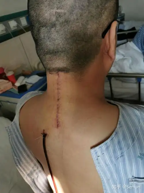 记录一下我的颈椎间盘突出手术过程吧