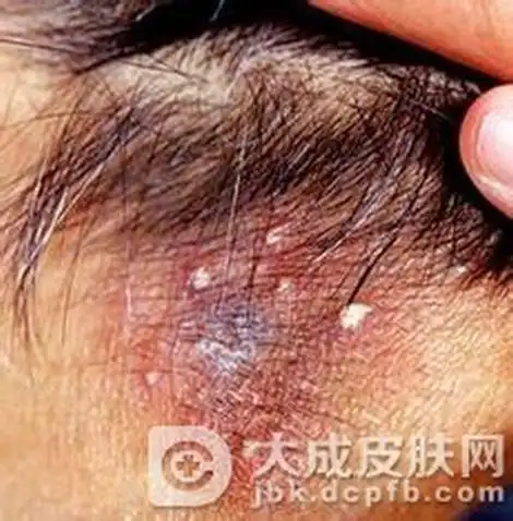 我们就碰到过因为护垫引发大腿内侧红肿瘙痒的女性朋友,尤其是腹股沟