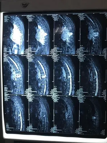 胸椎核磁可见肿瘤严重侵犯胸椎椎体
