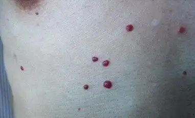 这是一种常见的良性血管瘤,叫樱桃状血管瘤,也称老年性血管瘤,虽然称