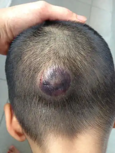 小孩头摔了一个包有肿块怎么办?