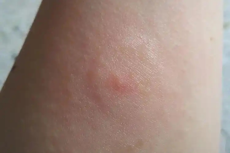 虱子咬的红疙瘩图片