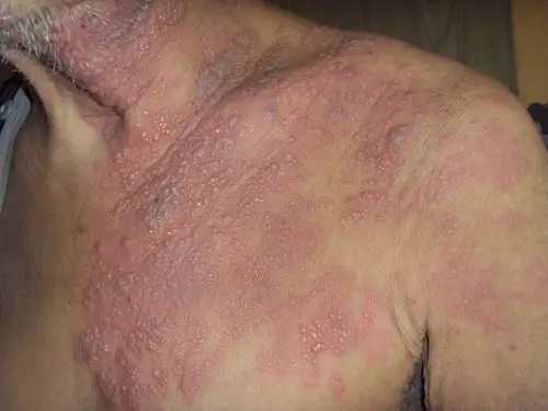 大面积带状疱疹图片