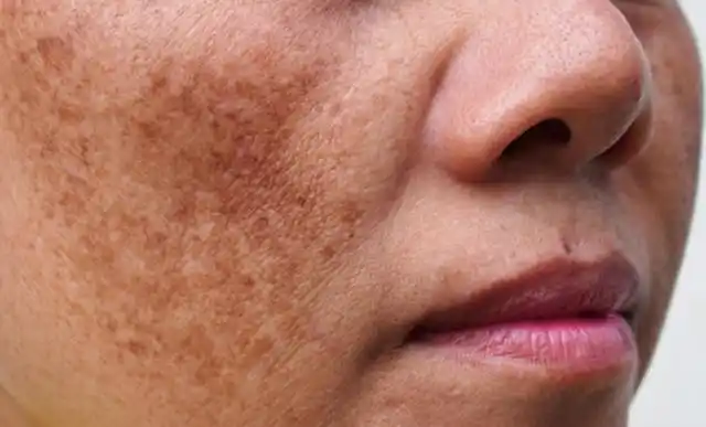 预防紫外线,一些色素性疾病出现的概率就会提升,例如黄褐斑,雀斑,晒斑