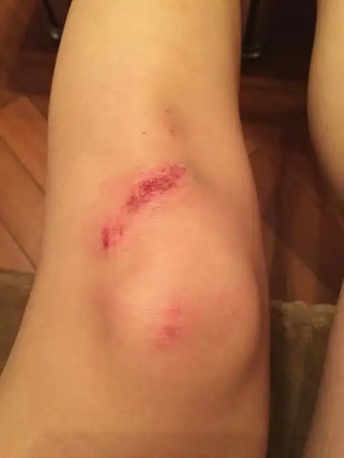 膝盖摔破皮了 还能进行什么运动吗