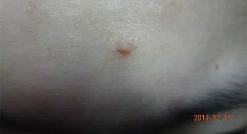 额头上长了一颗小肉球啊,怎么办?