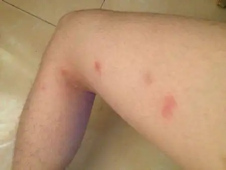 女性性病的症状