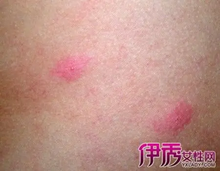 【图】热性荨麻疹如何治疗和预防呢 我们应该忌什么 呢