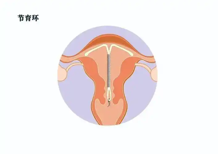 放置曼月乐环后可以健身运动吗?会不会移位?_安曼月_进行_治疗
