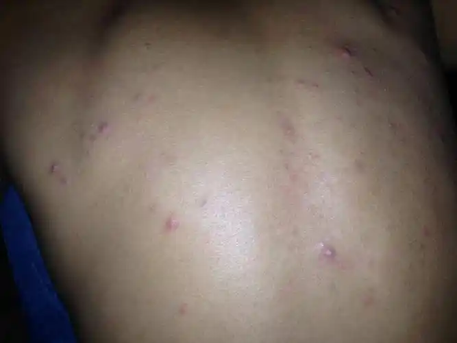 最近发现后背长出这多很像痘痘的东西.