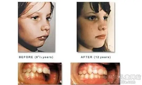 龅牙如何自己矫正 龅牙的分类有哪些