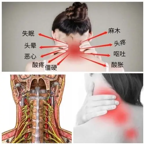 颈椎生理曲度变直那么可怕,你真的不考虑纠正一下吗?