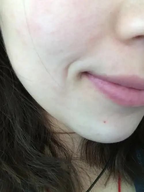 【汗】过敏皮肤干燥,在这么短的时间长了嘴角纹!