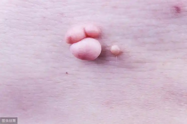 脖子上长小肉芽,有可能是这2种病,搞错了可能会有癌化风险