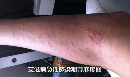 艾滋病初期小红点照片 出现的一种皮损表现