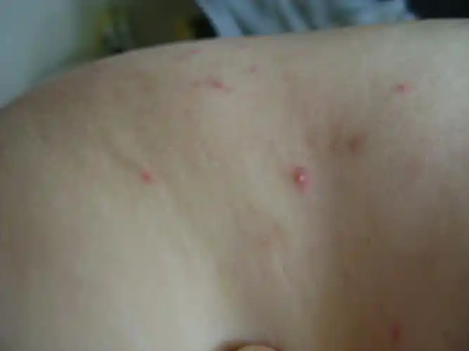 大腿内侧起了好多红疙瘩,有白色头,像脸上起的那种,怎么办?