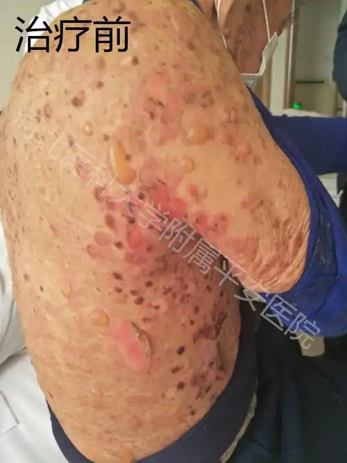 大疱性类天疱疮老人康复出院中西医结合发挥治疗优势