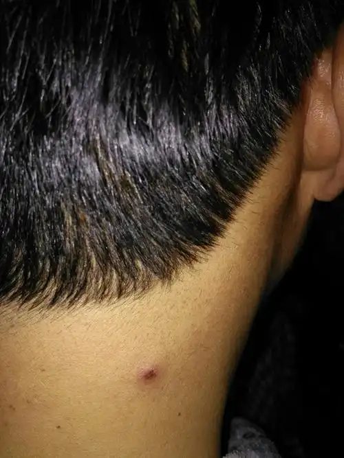 颈部脂肪瘤虽不痛不痒,但毕竟是病变异物,试用艾炙后竟然在2次后出现