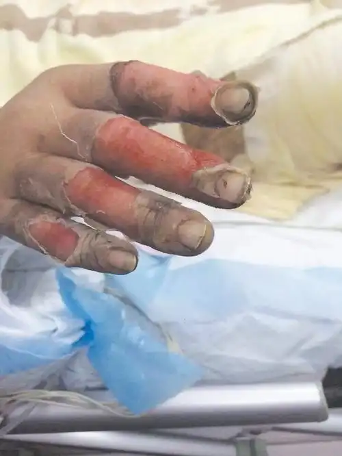 上山祭祀被烧伤后续治疗需二三十万 路桥妈妈求助