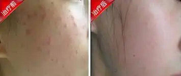 【扁平疣】激光动力综合疗法 告别扁平疣不留瘢痕