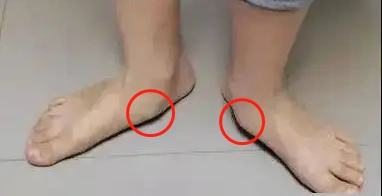 孩子足内侧鼓包凸起,按压会疼,走路也疼?警惕副舟骨问题!