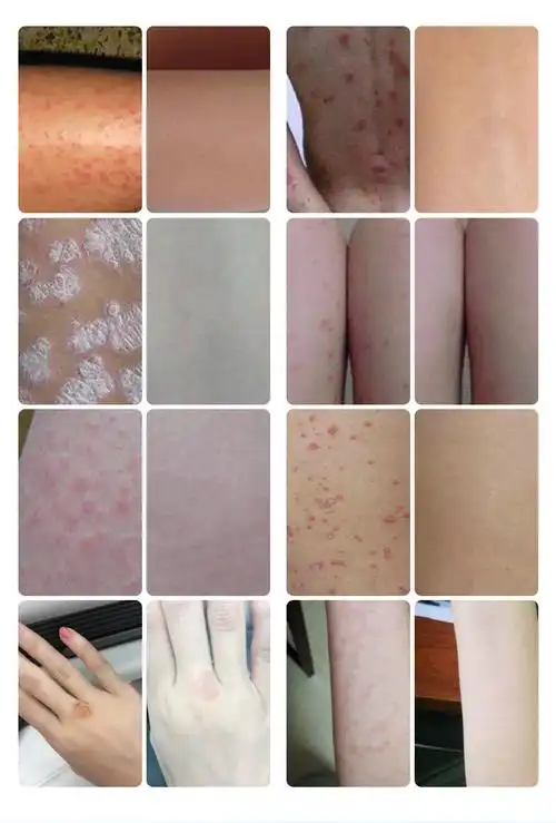 止痒膏皮肤抑菌外用外阴瘙痒肛门女性私处软膏阴囊潮湿屁眼痒乳膏