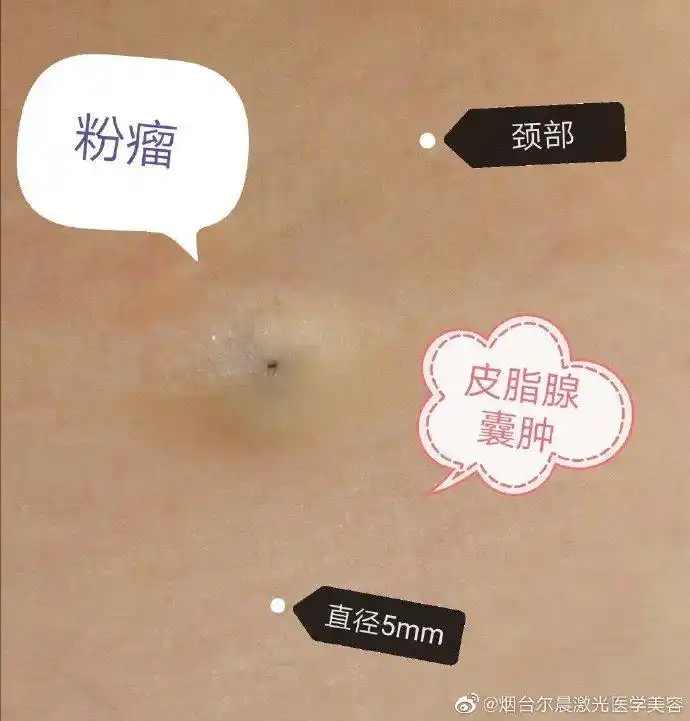 粉瘤术语叫皮脂腺囊肿,严格来说是一种皮肤的错构瘤,就是说发育的时候