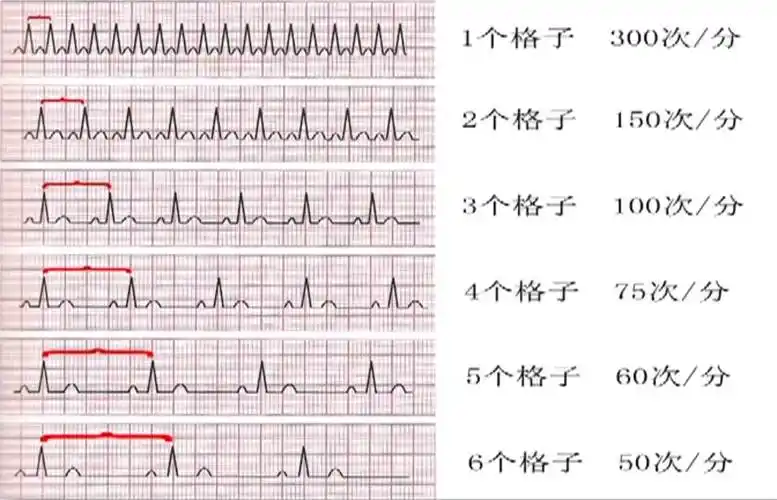 心电图图形顺序解读巧算心率