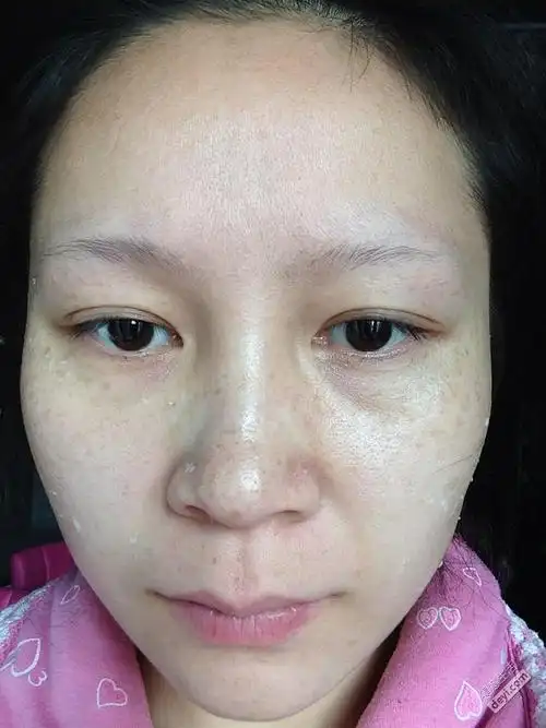 脸上的斑点终于去掉了,我要做个干净的女人