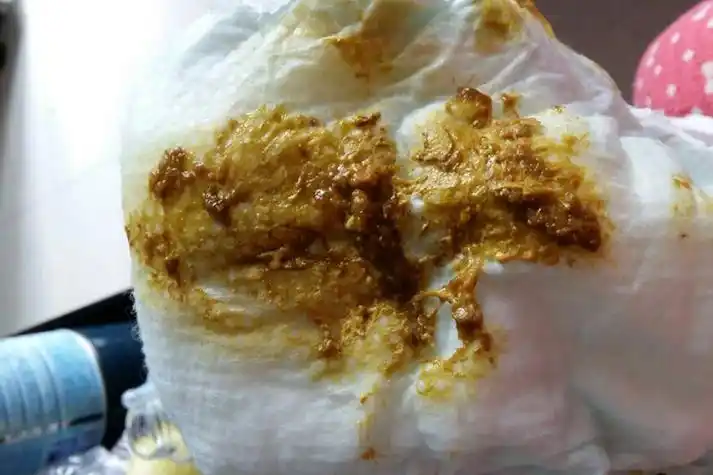 大便有棕色黏液图