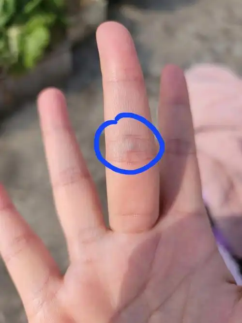 手上血管长了个疙瘩是什么