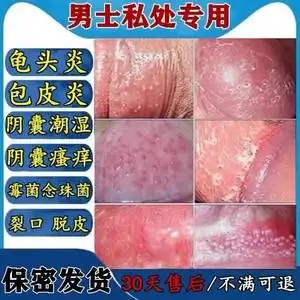 霉菌性龟头炎治疗包皮炎消炎膏红白点肿阴囊潮湿脱皮裂口专用药膏