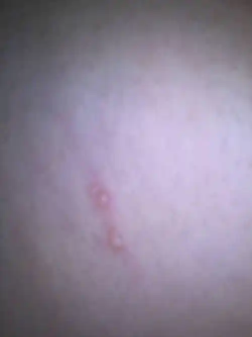 2013-12-15 陈巧梅 医师 今天发现小腿长了一个暗红色的水泡.