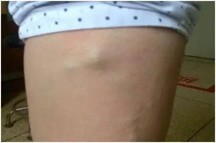 表层血管像蚯蚓一样曲张,明显凸出皮肤,曲张呈团状或结节状; 2.