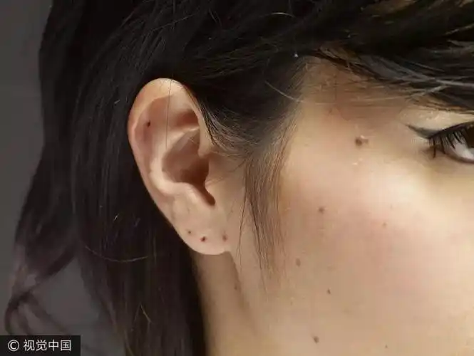 一颗黑痣流血没理会,33岁爸爸癌细胞扩散……遇到这种情况千万要重视!