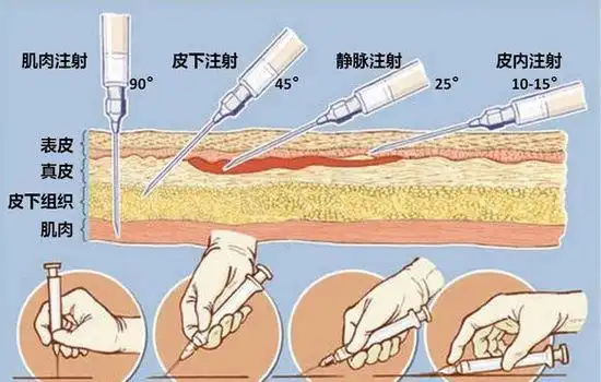 除了口服,有哪些花式给药途径?