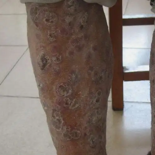 常见方法淋病的早期症状淋病的治疗方法