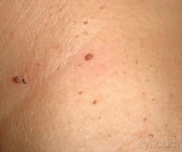 颈部的疣 - 皮肤及性传播疾病讨论版 - 爱爱医医学论坛