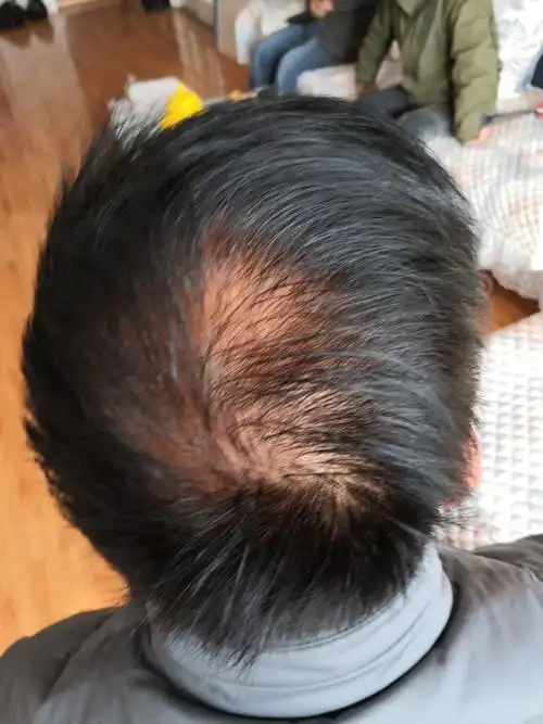 头发稀少,脱落怎么办?