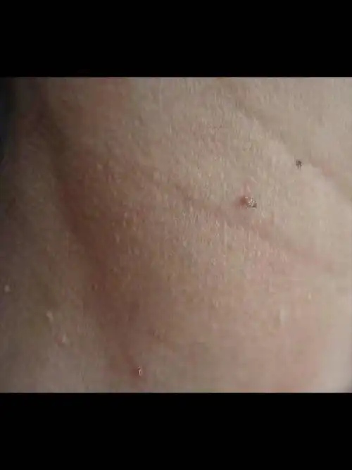 张大姐脖子长小肉粒确诊丝状疣这两种方法治疗去除