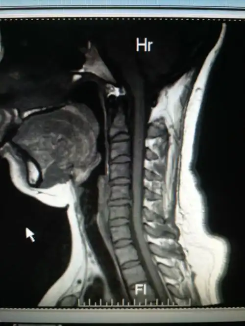 如果想更加直观立体的了解颈椎,那么我们的颈椎ct三维重建亦可