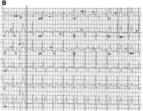 心电图挑战:电轴右偏探秘 - 丁香园