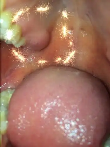 昨天嘴巴里长出了个硬包,很硬(像骨头般的硬)不疼不痒.