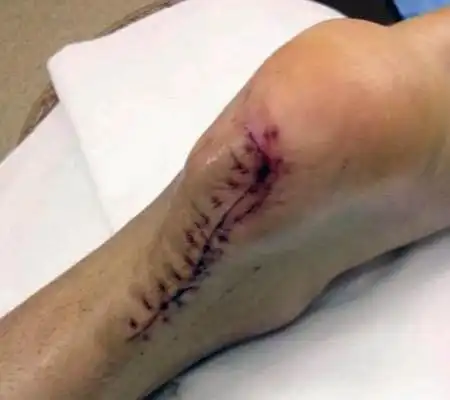 刘翔的脚伤触目惊心