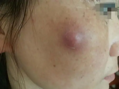 面部粉瘤感染.