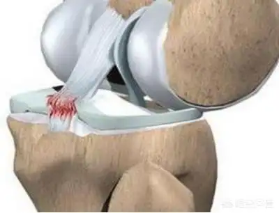 膝盖交叉韧带拉伤怎么恢复
